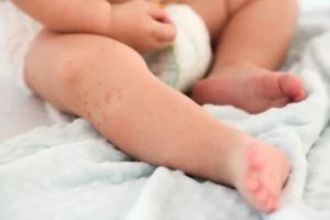 Understanding Eczema and Food Allergy Links in Babies